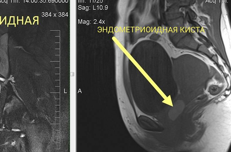 МРТ органов женского малого таза (матка, яичники, мочевой пузырь, влагалище, сосуды малого таза, лимфатические узлы)