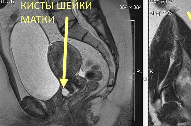МРТ органов женского малого таза (матка, яичники, мочевой пузырь, влагалище, сосуды малого таза, лимфатические узлы)