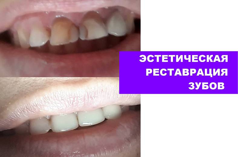 Первичный прием стоматолога с диагностикой интраоральной видеокамерой