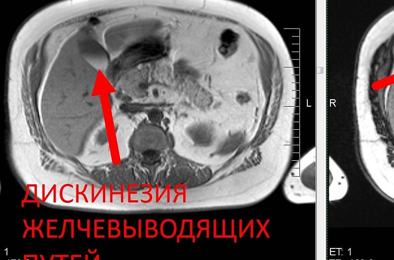 МРТ органов брюшной полости и холангиография (детальный осмотр внутри и вне печеночных желчных протоков)