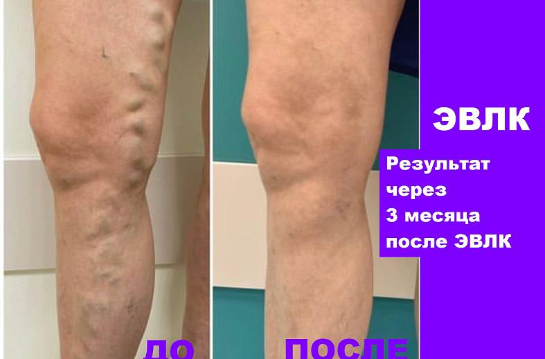 Эндовенозная лазерная коагуляция - ЭВЛК одной магистральной вены нижней конечности ( лазерным аппаратом "FiberLase S")