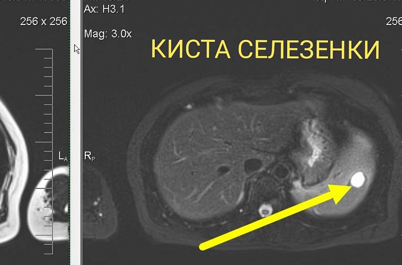МРТ органов брюшной полости и холангиография (детальный осмотр внутри и вне печеночных желчных протоков)