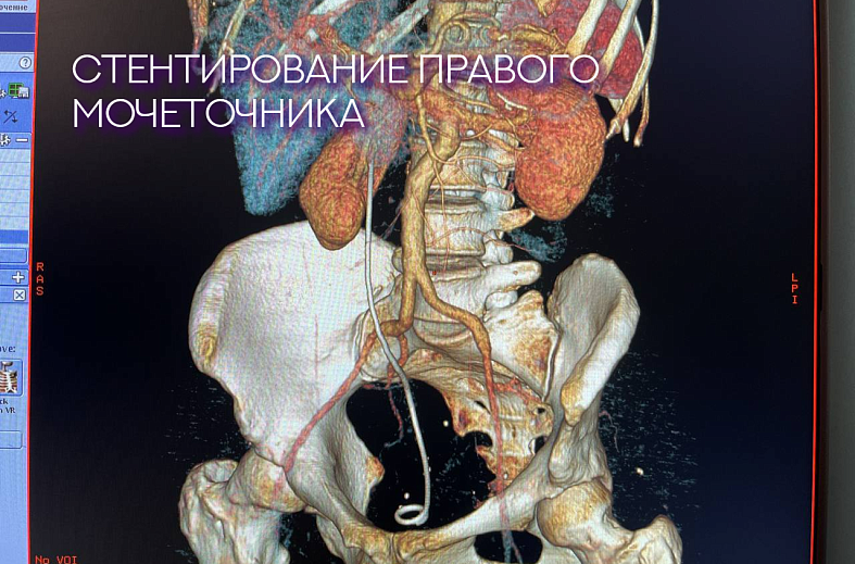 КТ мочевыводящих путей, экскреторная урография (почки, мочеточники, мочевой пузырь, лимфатические узлы)
