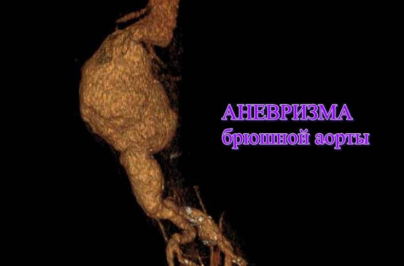 КТ брюшной аорты