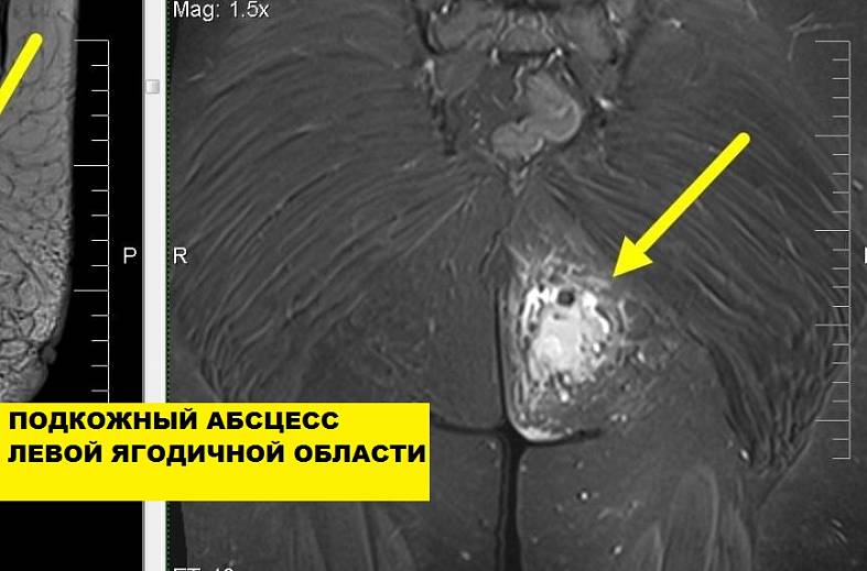 МРТ мягких тканей конечности (одна область)