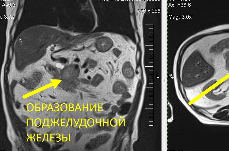 МРТ органов брюшной полости и холангиография (детальный осмотр внутри и вне печеночных желчных протоков)