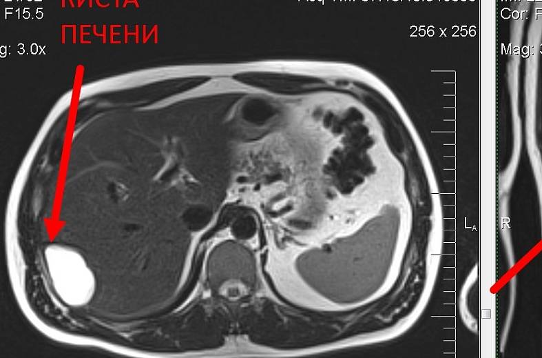 МРТ органов брюшной полости и холангиография (детальный осмотр внутри и вне печеночных желчных протоков)
