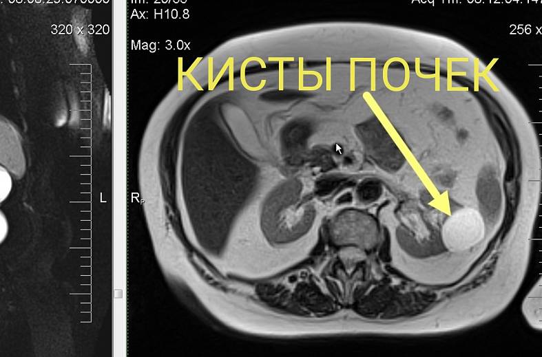МРТ органов забрюшинного пространства (почки, надпочечники, нижняя полая вена, лимфатические узлы, брюшной отдел аорты)