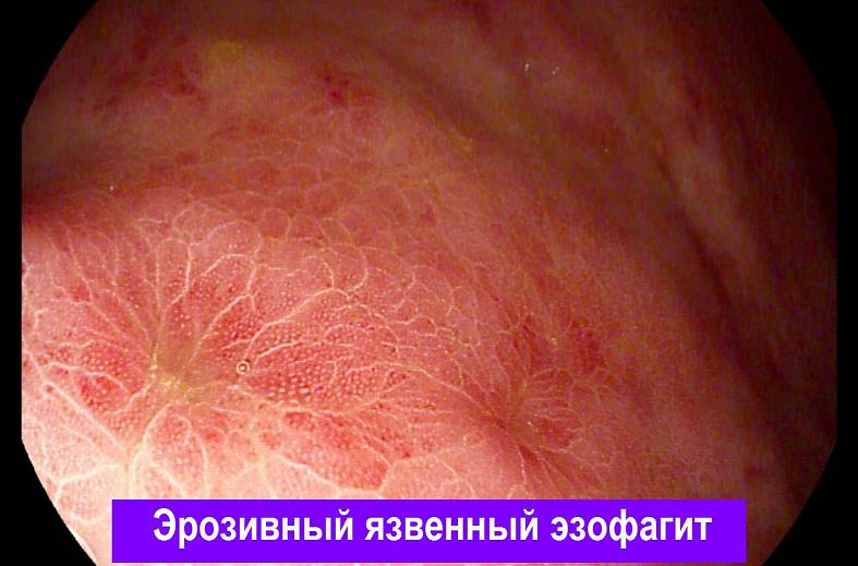 Видеогастроскопия аппаратом expert "PENTAX i7010" экспертного класса
