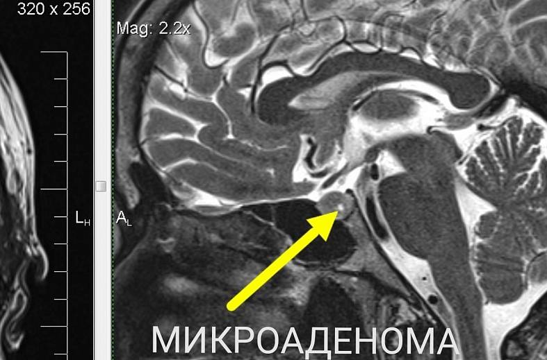 МРТ гипофиза 
