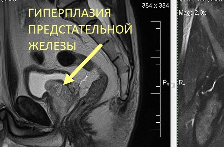 Диффузно-взвешенное магнитно-резонансное изображение (DWI MRI) ( для обеспечивания контрастности картинки)
