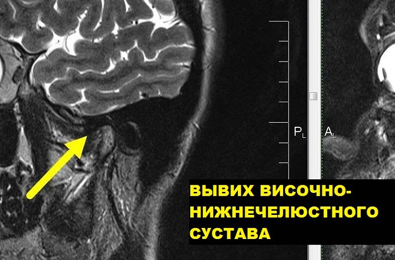 МРТ-исследование височно-нижнечелюстных суставов