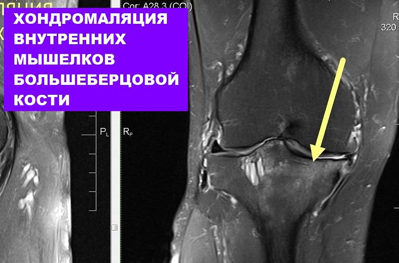 МРТ коленного сустава на 15-канальной катушке