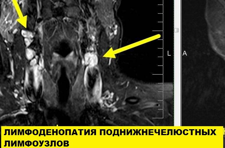 МРТ мягких тканей шеи
