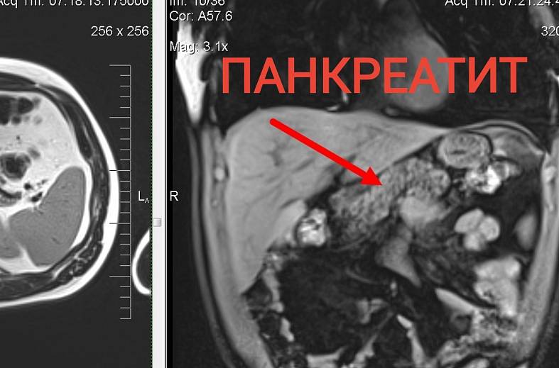 МРТ органов брюшной полости и холангиография (детальный осмотр внутри и вне печеночных желчных протоков)