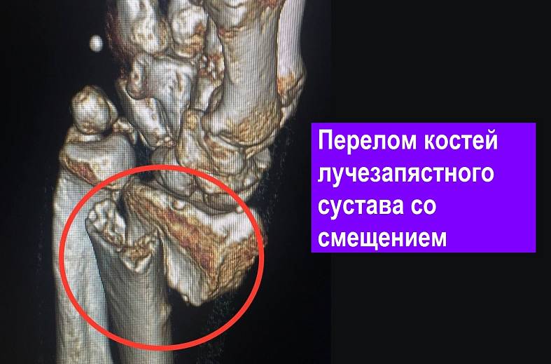 КТ лучезапястного сустава