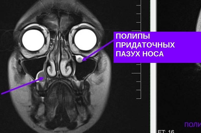МРТ придаточных пазух носа