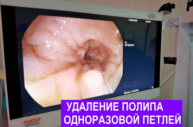 Видеоколоноскопия экспертного класса на аппарате Pentax i7010 (Япония) expert