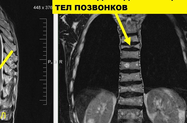 МРТ грудного отдела позвоночника