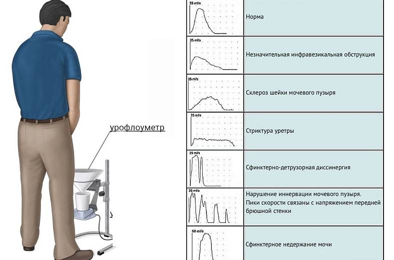 Урофлоуметрия - измерение скорости потока мочи
