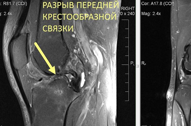 МРТ коленного сустава на 15-канальной катушке