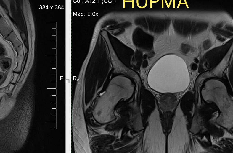Диффузно-взвешенное магнитно-резонансное изображение (DWI MRI) ( для обеспечивания контрастности картинки)