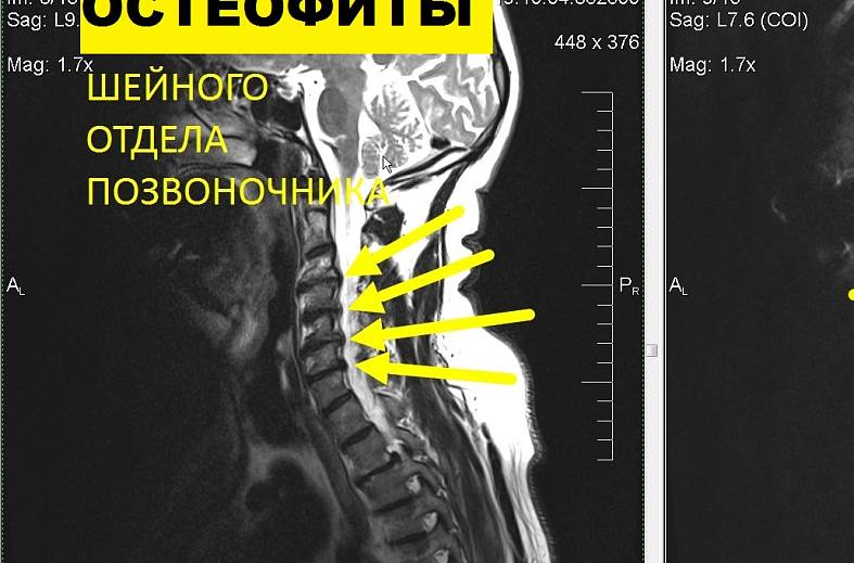 МРТ шейного отдела позвоночника