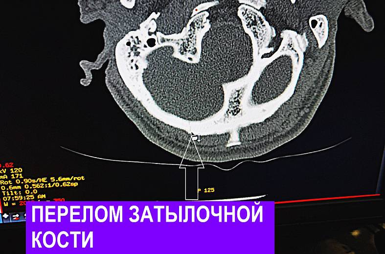 КТ костей черепа