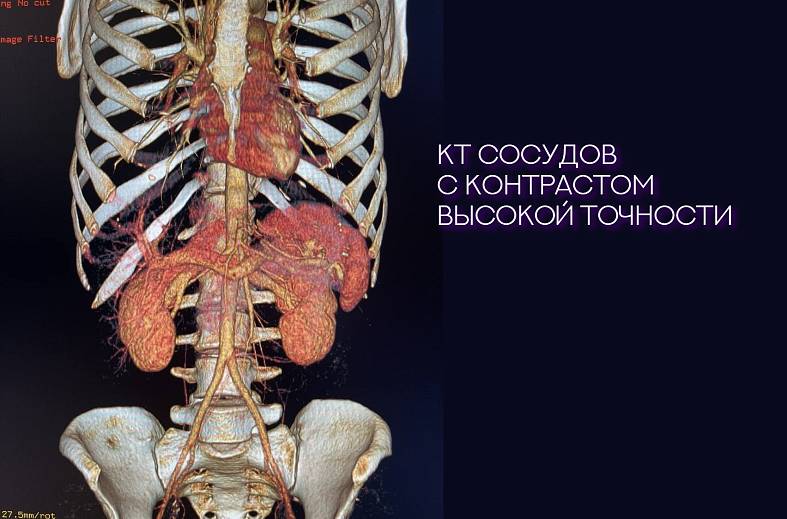 КТ 1 доза, болюсное контрастирование (вводится внутривенно препарат йодосодержащий) 50мг