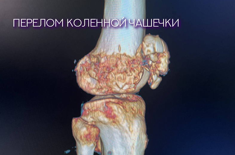 КТ коленного сустава