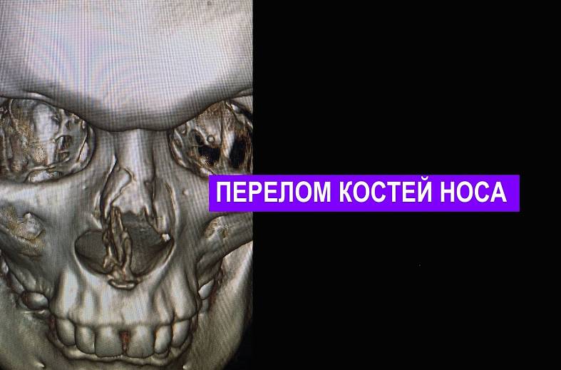 КТ придаточных пазух носа