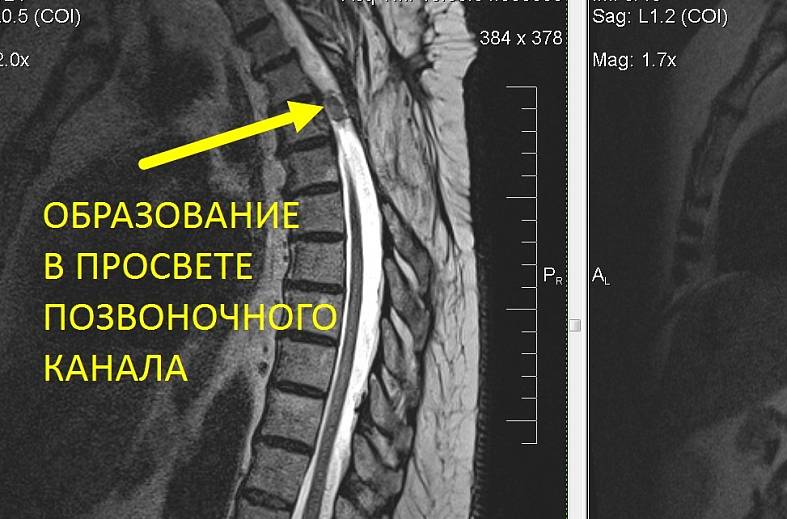 МРТ грудного отдела позвоночника