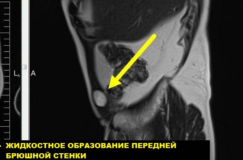 МРТ мягких тканей (одна область)