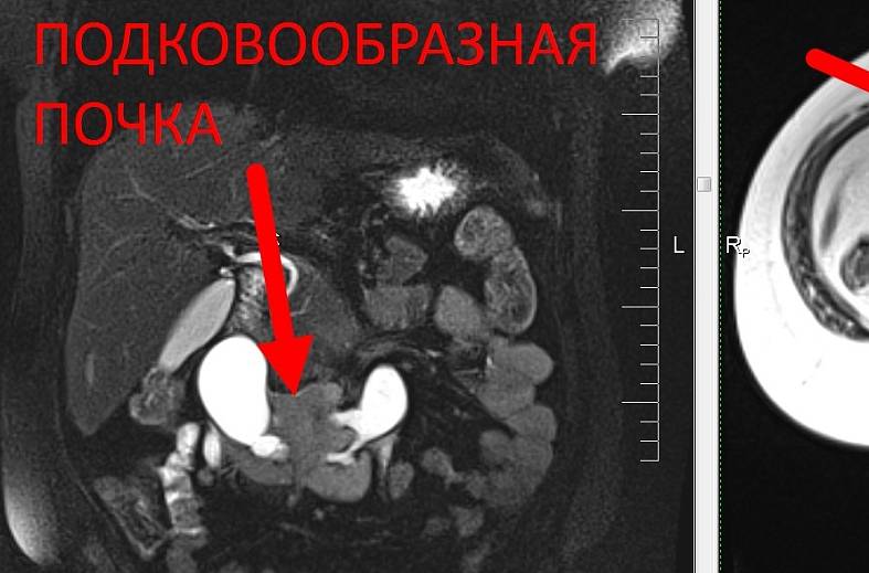МРТ органов забрюшинного пространства (почки, надпочечники, нижняя полая вена, лимфатические узлы, брюшной отдел аорты)