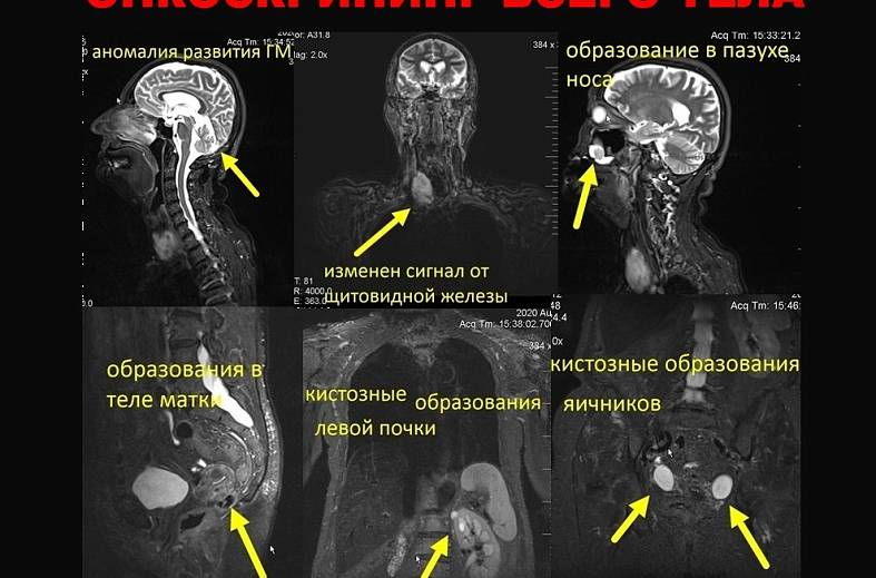 Онкоскрининг всего тела