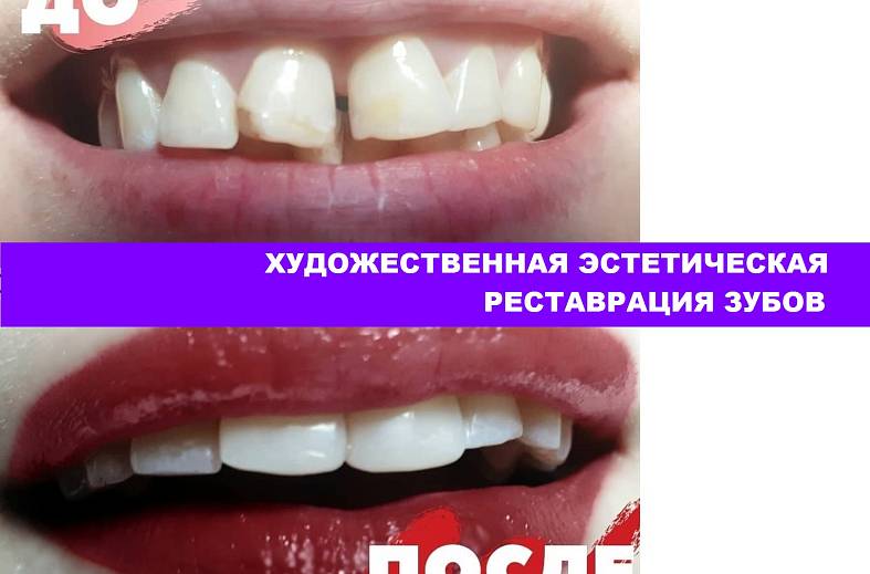Лечение среднего кариеса