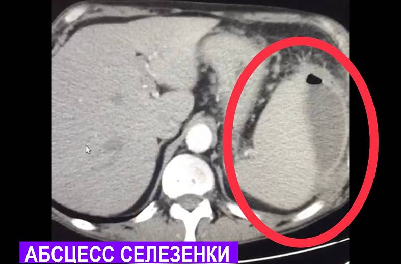 КТ селезенки