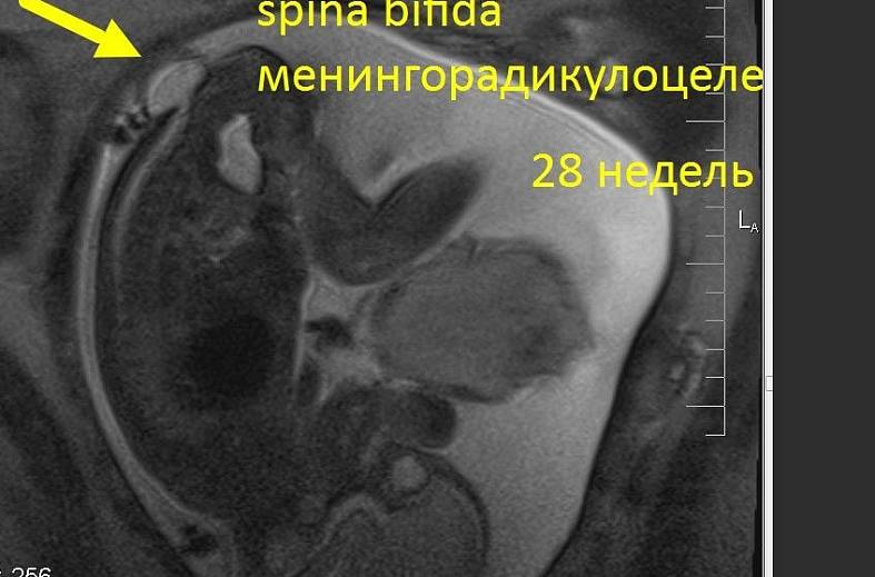 МРТ беременности с 22 недели (пороки развития плода, патология матери, определение пола)