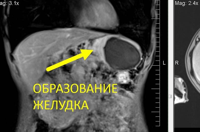 МРТ-желудка с пероральным контрастированием
