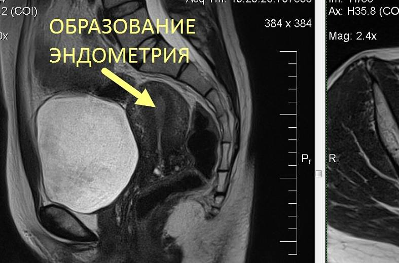 МРТ органов женского малого таза (матка, яичники, мочевой пузырь, влагалище, сосуды малого таза, лимфатические узлы)
