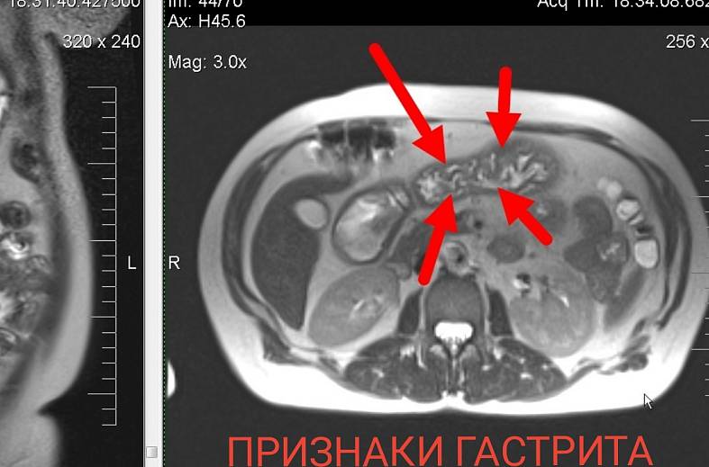МРТ-желудка с пероральным контрастированием