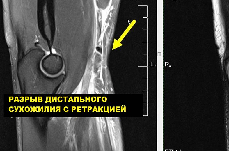 МРТ локтевого сустава