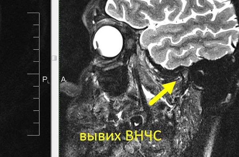МРТ-исследование височно-нижнечелюстных суставов