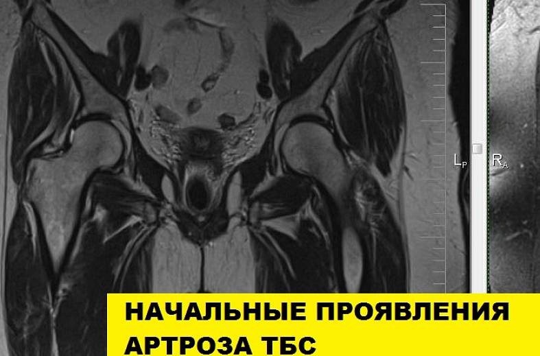 МРТ тазобедренных суставов (пара суставов)