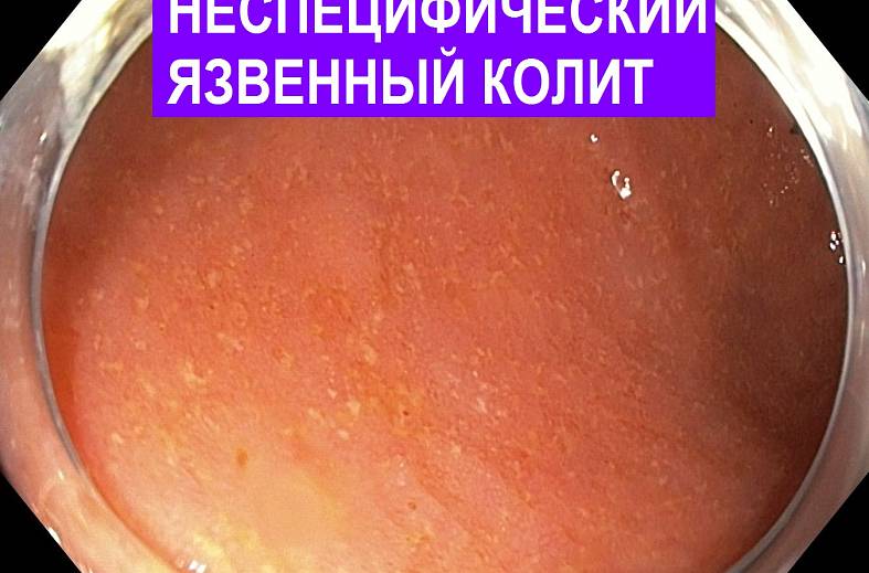 Видеоколоноскопия экспертного класса на аппарате Pentax i7010 (Япония) expert