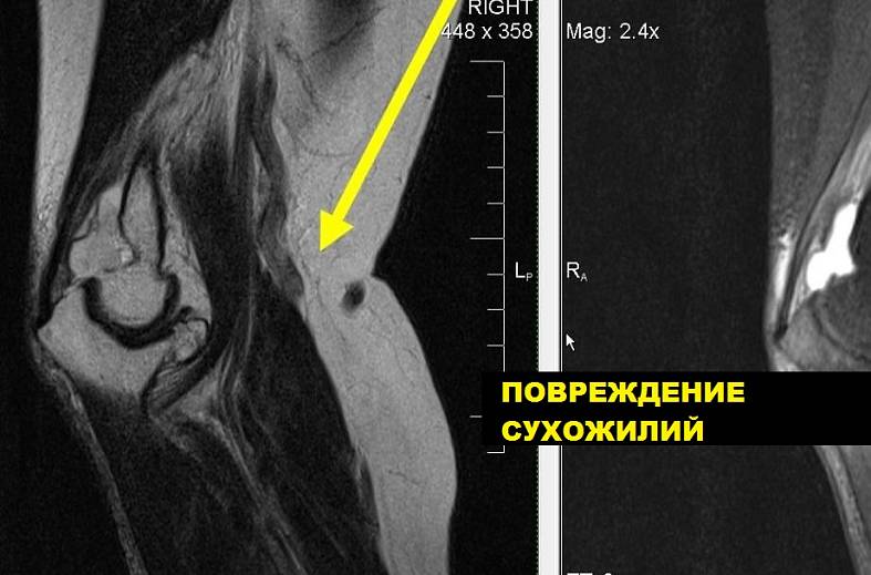 МРТ локтевого сустава