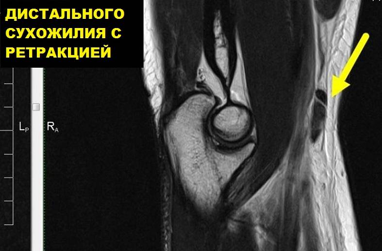 МРТ локтевого сустава