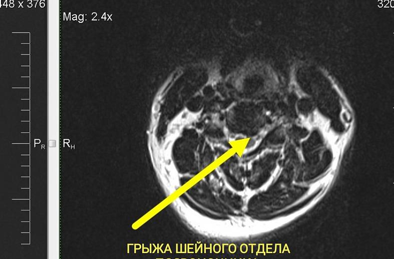 МРТ шейного отдела позвоночника