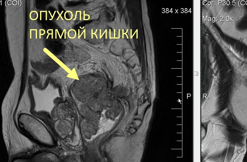МРТ толстого кишечника (колонография)