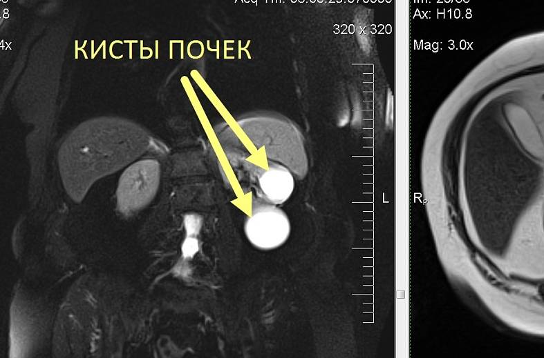 МРТ органов брюшной полости и забрюшинного пространства (печень, поджелудочная железа, селезенка, желчный пузырь, почки, надпочечники) 